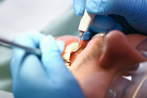 Best Dental Abscess Treatment in Huntertown, IN